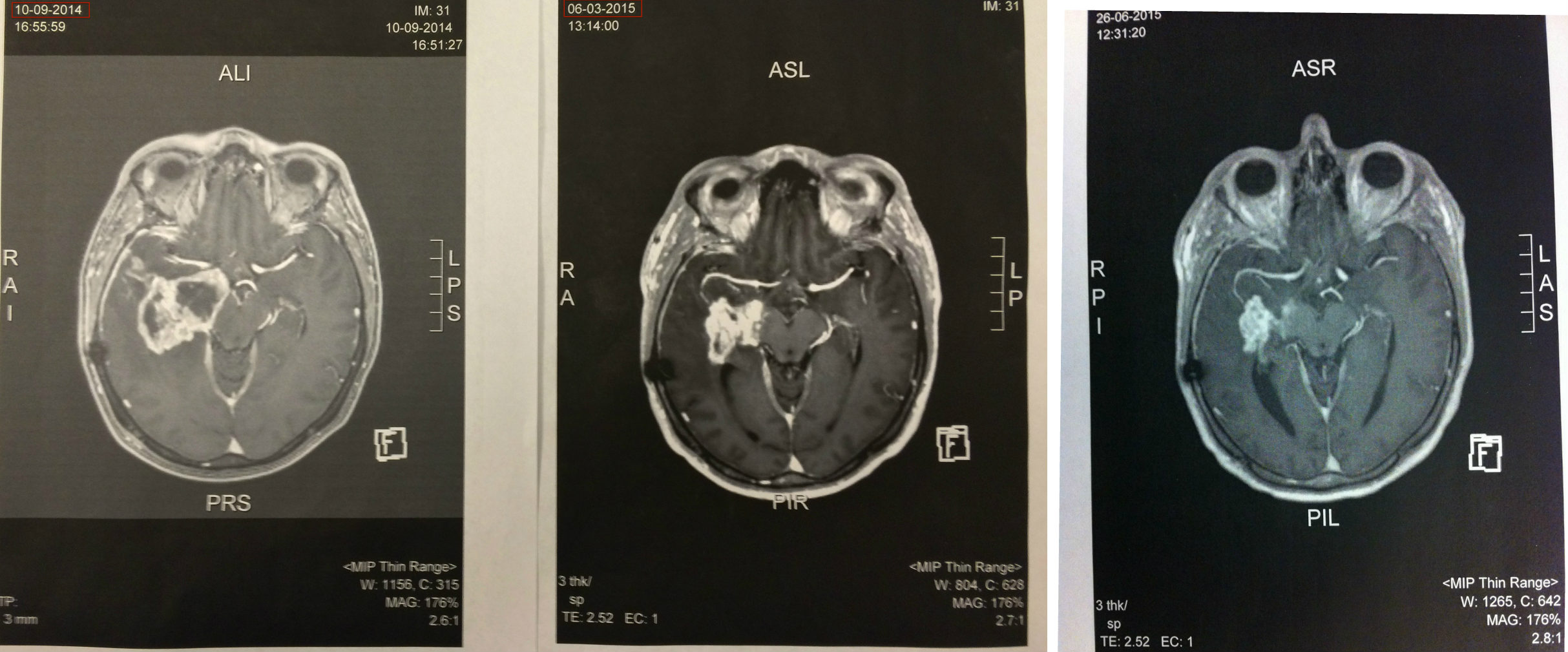 Grade 4 Glioblastoma Multiforme Brain Cancer - CancerWalls